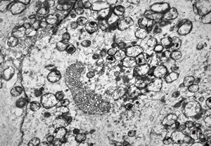 F,44y. | ependymoma F,44y. | ependymoma